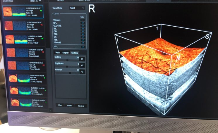 3D OCT Eye Scans: Early Detection