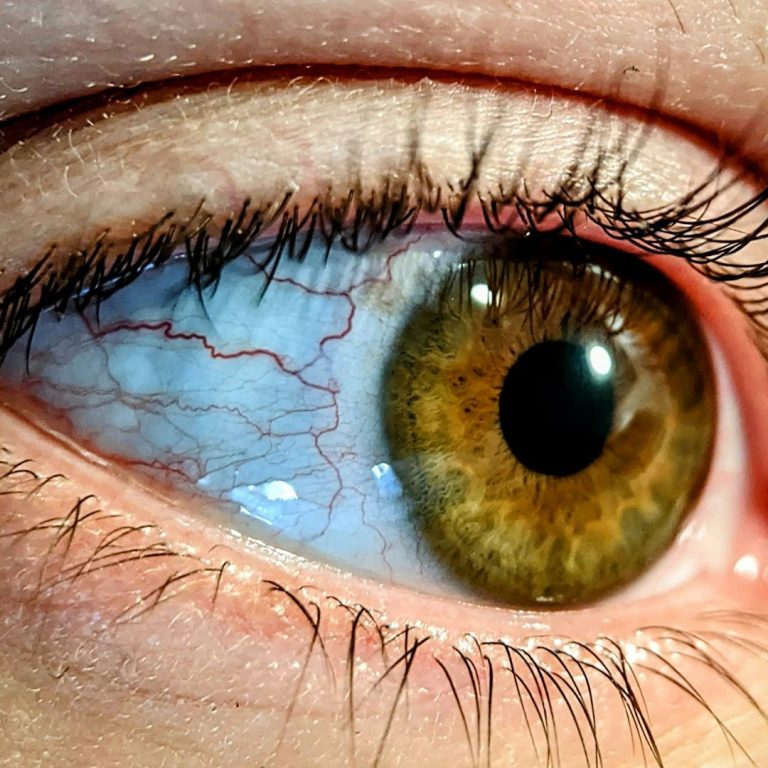 A sore eye
